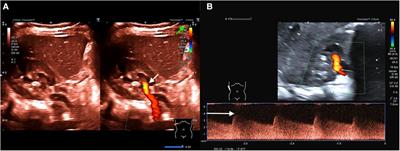 Case Report: Renal artery stenosis in children: ultrasound as a decisive diagnostic and therapy-accompanying technique!